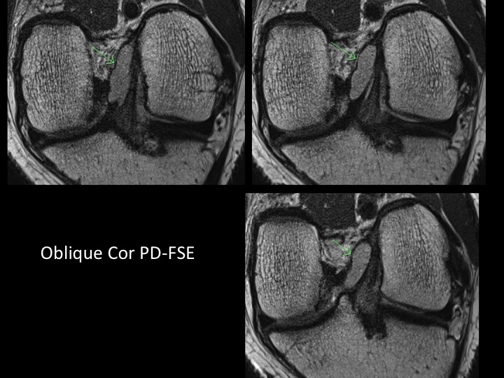 Figure 3 for case anteromedial bundle of anterior cruciate ligament ( RID2782 )